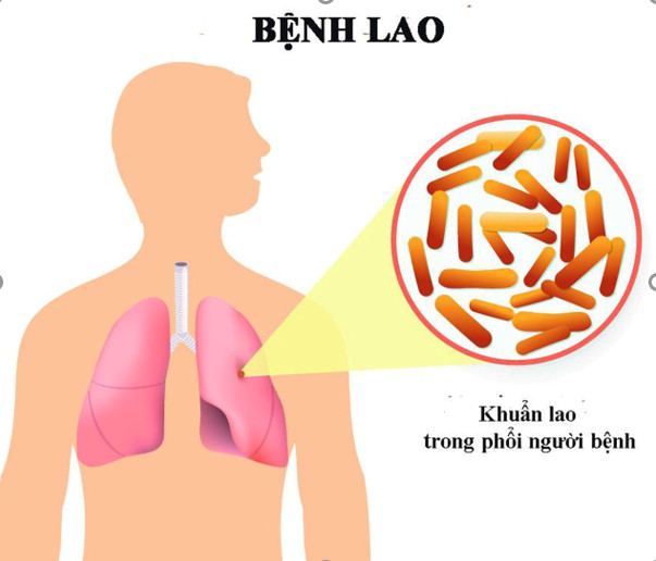 Bệnh lao - những điều cần biết về bệnh Lao